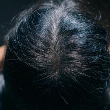 中医视角下的脂溢性脱发:血热风燥与脾胃失和所致